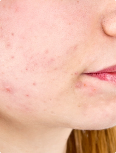 image skin rash on cheek 463538569 - Facial Contouring & Skin Tightening