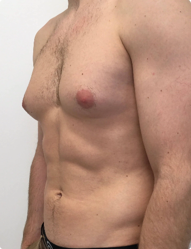 male breast reduction Male Breast Reduction 25 - BodyTite