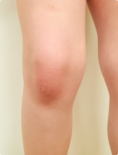 swollen knees 1566317866 - Liposuction
