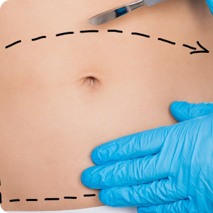 Abdominoplasty Surgery - Procedures